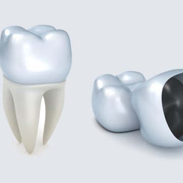How Dental Crowns Help Protect and Restore Cracked Teeth
